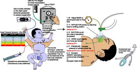 Neonatal Resuscitation Pediatric Nursing