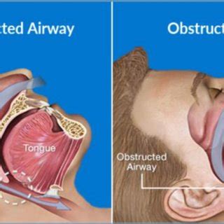 Obstruction Of The Upper Airway Https Sciencebasedmedicine Org