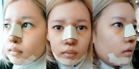 Gangnam Plastic Surgery Before And After