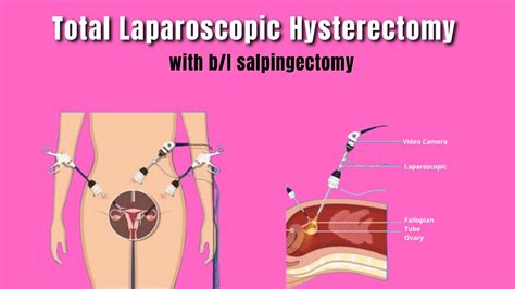 Total Laparoscopic Hysterectomy With Bl Salpingectomy Dr Aruna Kalra Youtube