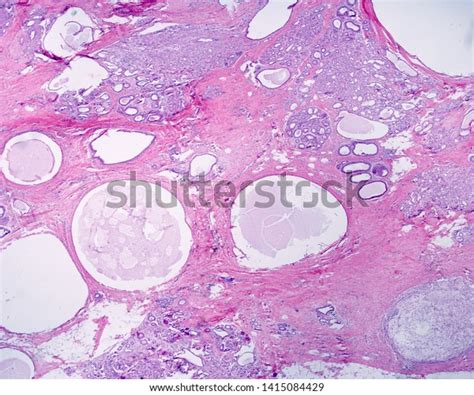 Human Breast Gland Fibrocystic Changes Breast Stock Photo 1415084429