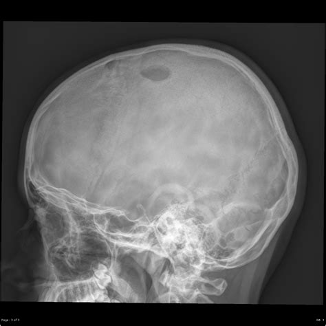 Eosinophilic Granuloma Skull Image