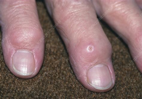 Deformed Fingers Due To Rheumatoid Arthritis Stock Image M1100328