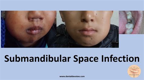 Submandibular Space Infection Treatment By Dr Raman Dhungel Youtube