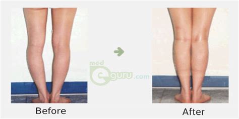 Correction Of Bow Legs How To Fix Bowed Legmed E Guru