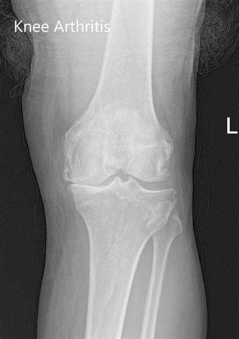 Case Study Customized Left Knee Replacement In An 81 Year Old Patient