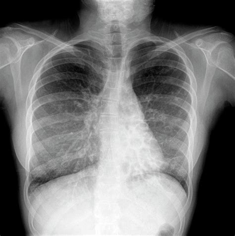 Cystic Fibrosis Photograph By Photostock Israel Science Photo Library