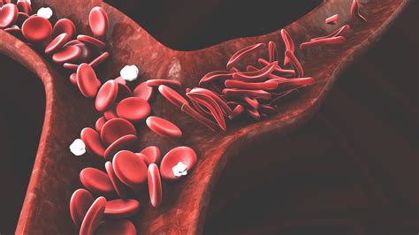 Quem Tem Traços De Anemia Falciforme Pode Doar Sangue