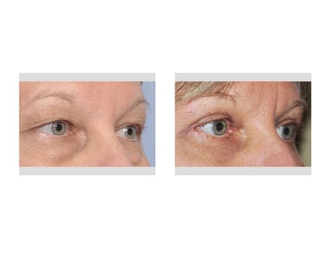 Essential Steps In Upper Blepharoplasty Surgery Explore Plastic Surgery