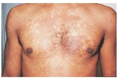 Fungal Bacterial And Viral Infections Of The Skin Part 2