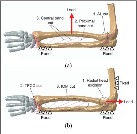 Figure From Contribution Of A Distal Radioulnar Joint Stabilizer On Forearm Stability A