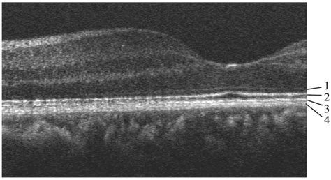 Oct B Scan Of Human Retina Centered 4° Nasal Image Size 29 Mm 1600