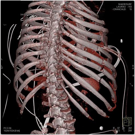 Rib Fracture Fractures Medical Imaging Radiology Pediatrics Case