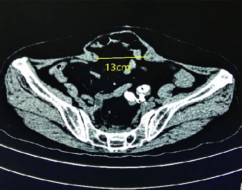 Representative Ct Diagnostic Image Of Giant Incision Hernia Maximal