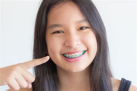 With a slight force, brush around your braces using clockwise and anticlockwise direction. How to Brush Your Teeth with Braces, Bliss Dental ...