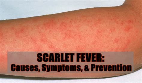 Scarlet Fever Causes Symptoms And Prevention