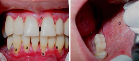 Patient With Systemic Lupus Erythematosus With Gingival And Tooth