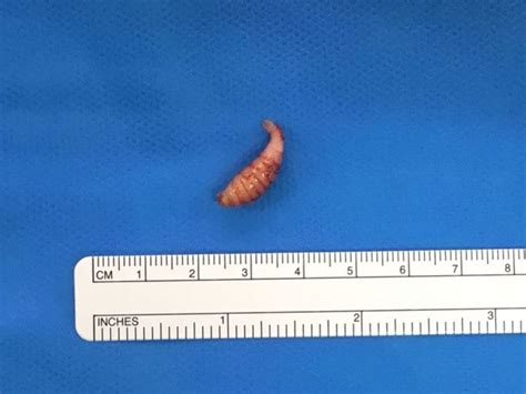 Bumps On A Uk Womans Scalp Turned Out To Be Botfly Larvae