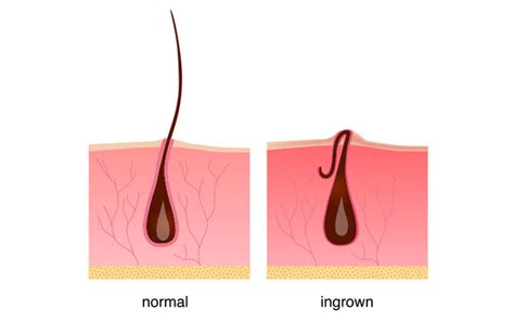 Infected Ingrown Pubic Hair Symptoms Ingrown Hair On Penile Shaft