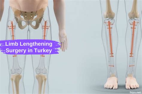 Limb Lengthening Surgery In Turkey The Ideal Solution For