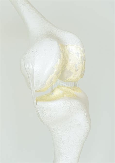 Advanced Osteoarthritis Stage 3 On The Knee Joint High Degree Of