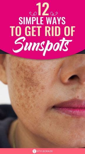 How To Get Rid Of Sunspots Sun Spots On Skin Sunspots On Face Beauty Tips And Secrets