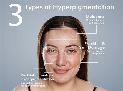 All About Hyperpigmentation Dermphysicians Of New England