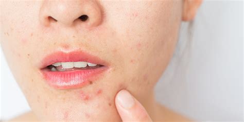 Acne Scars Causes Prevention And Treatment Waxelene
