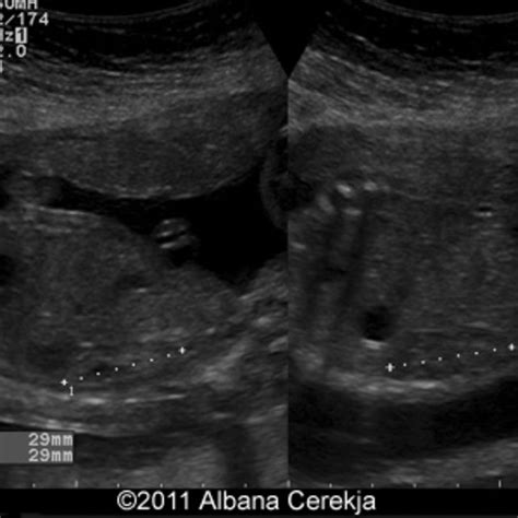 📃 Duplex Kidney