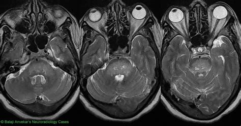 Neuroradiology Cases Central Pontine Myelinolysis