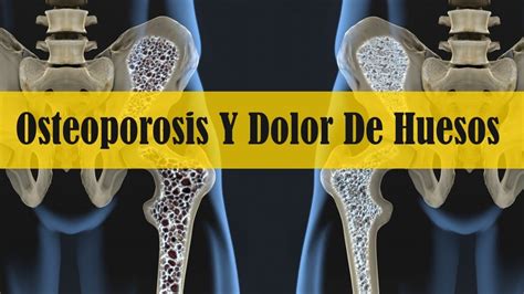 Dolor De Huesos Y Osteoporosis Remedios Caseros Youtube