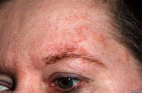 Skin Disease Types Seborrheic Dermatitis