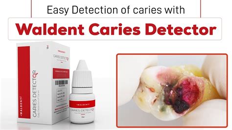Easy Detection Of Caries With Waldent Caries Detector Youtube
