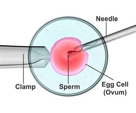 Intracytoplasmic Sperm Injection Icsi Male Infertility Treatment