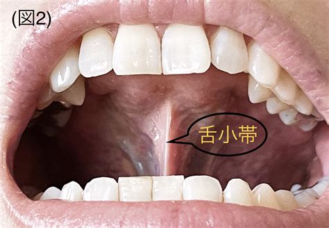舌のトレーニング アクア矯正歯科クリニック 矯正、綺麗な歯並び維持・改善 舌のトレーニング