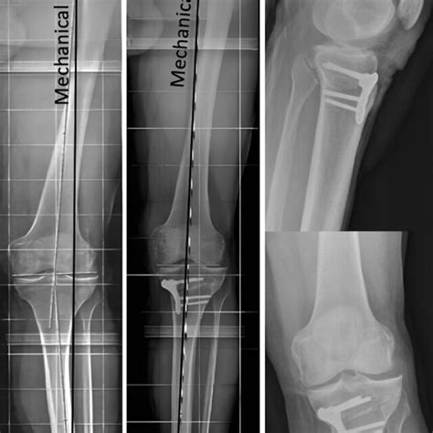 Medial Closing Wedge High Tibial Osteotomy Performed With Locked Plate