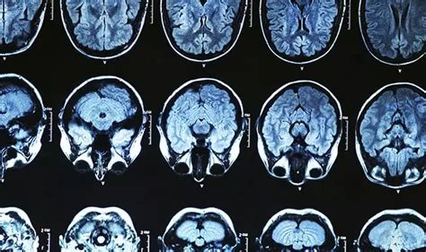 Jornal Crescer Eua Aprovam Novo Medicamento Para O Alzheimer Pela Primeira Vez Em Anos