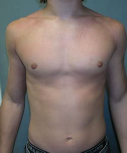 Puffy Nipples In Men Gynecomastia Surgery Ny Mordcai Blau Md