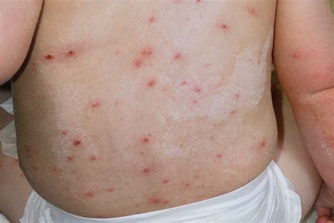 Chickenpox Varicella Zoster Clinical Review GPonline