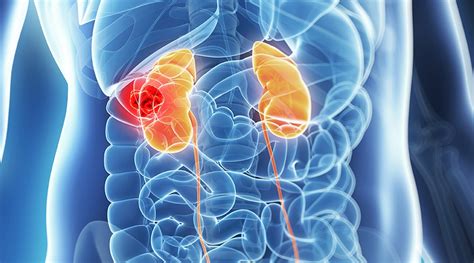 What Is Kidney Cancer What Are The Symptoms How Is It Treated