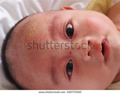 Atopic Dermatitis Seborrheic Dermatitis Baby Stock Photo 668731060
