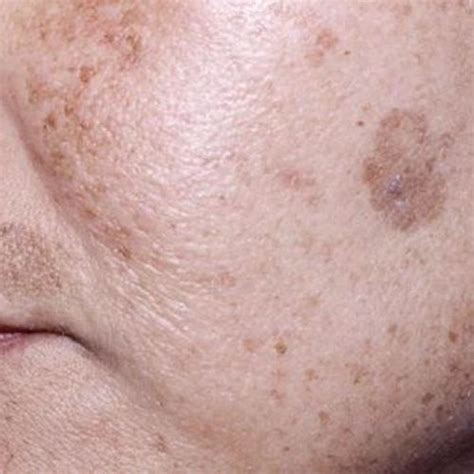 Pigmented Lesion Removal Ageliver Spots Skindevour