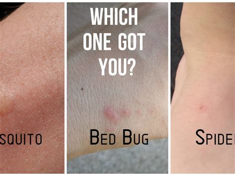 Marte Chiaramente Gloss Bed Bug Bites On Legs Prova La Chiesa Marea Di