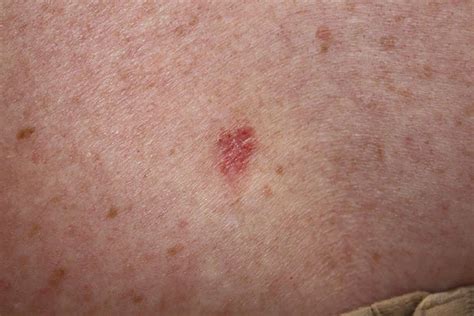 Skin Carcinomas Linked To Increased Risk Of Other Cancers
