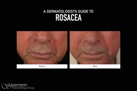 A Dermatologists Guide To Rosacea Siperstein Dermatology Group