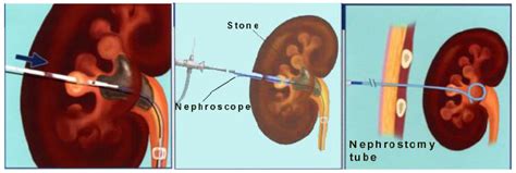 Percutaneous Nephrolithotomy Pcnl Chin Chong Min Urology And Robotic