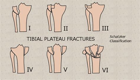Understanding Tibial Plateau Fractures Kneeguru Tibial Plateau