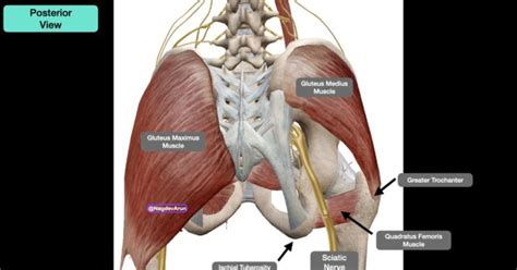 How To Relieve Sciatica Pain With New TransGluteal Nerve Block