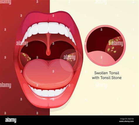 Tonsil Stone Stock Vector Images Alamy