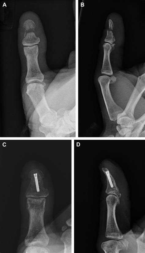 Treatment Of Nonunion And Malunion Following Hand Fractures Plastic